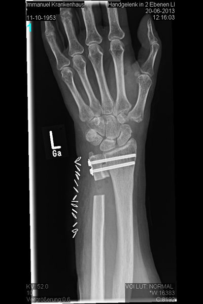 Röntgenbild nach Operation nach Kapandji-Sauve - Immanuel Krankenhaus Berlin - Orthopädie: Obere Extremität, Hand- und Mikrochirurgie - Hand - Versteifungsoperationen