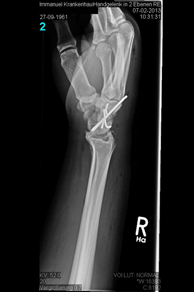 Röntgenbild nach Mediokarpaler Teilarthrodese - Immanuel Krankenhaus Berlin - Orthopädie: Obere Extremität, Hand- und Mikrochirurgie - Hand - Versteifungsoperationen