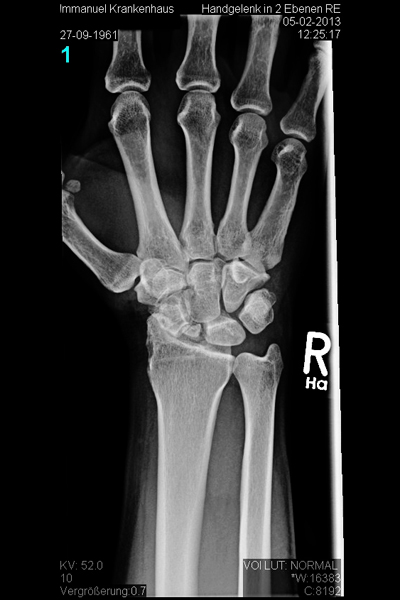 Röntgenbild einer radiokarpalen Arthrose nach alter Kahnbeinfraktur - Obere Extremität, Hand- und Mikrochirurgie - Immanuel Krankenhaus Berlin