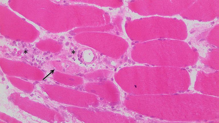 Immanuel Krankenhaus Berlin - Rheumatologie - Mikroskopisches Bild (sog. HE-Färbung) einer Muskelprobe mit Darstellung vieler Entzündungszellen (Sterne) und geschädigten Muskelzellen (Pfeil) als Zeichen der Muskelentzündung