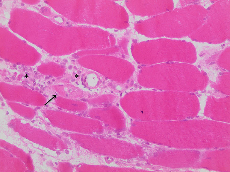 Immanuel Krankenhaus Berlin - Rheumatologie - Mikroskopisches Bild (sog. HE-Färbung) einer Muskelprobe mit Darstellung vieler Entzündungszellen (Sterne) und geschädigten Muskelzellen (Pfeil) als Zeichen der Muskelentzündung