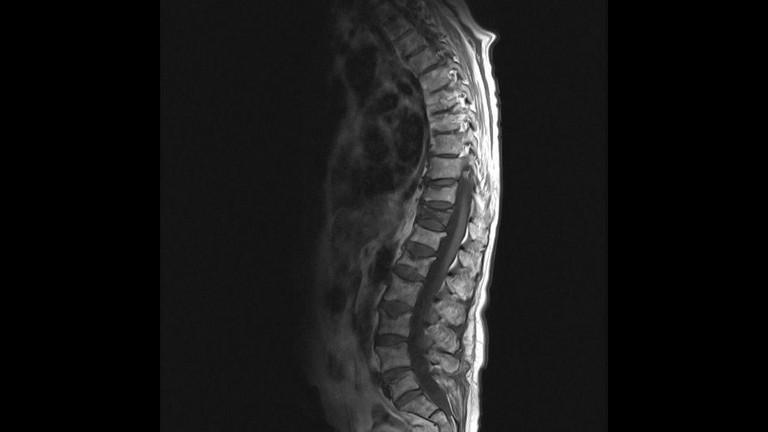 Röntgenbild Wirbelsäule